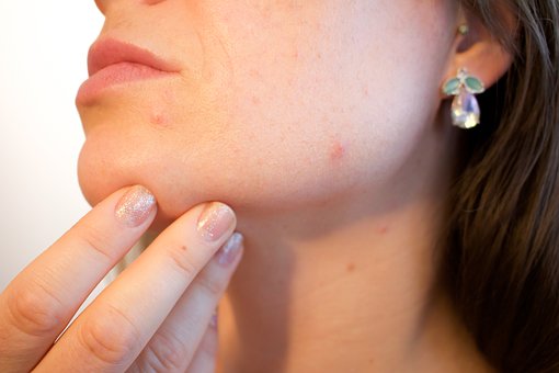 Curare l'acne con la dieta: cosa mangiare per migliorare la pelle