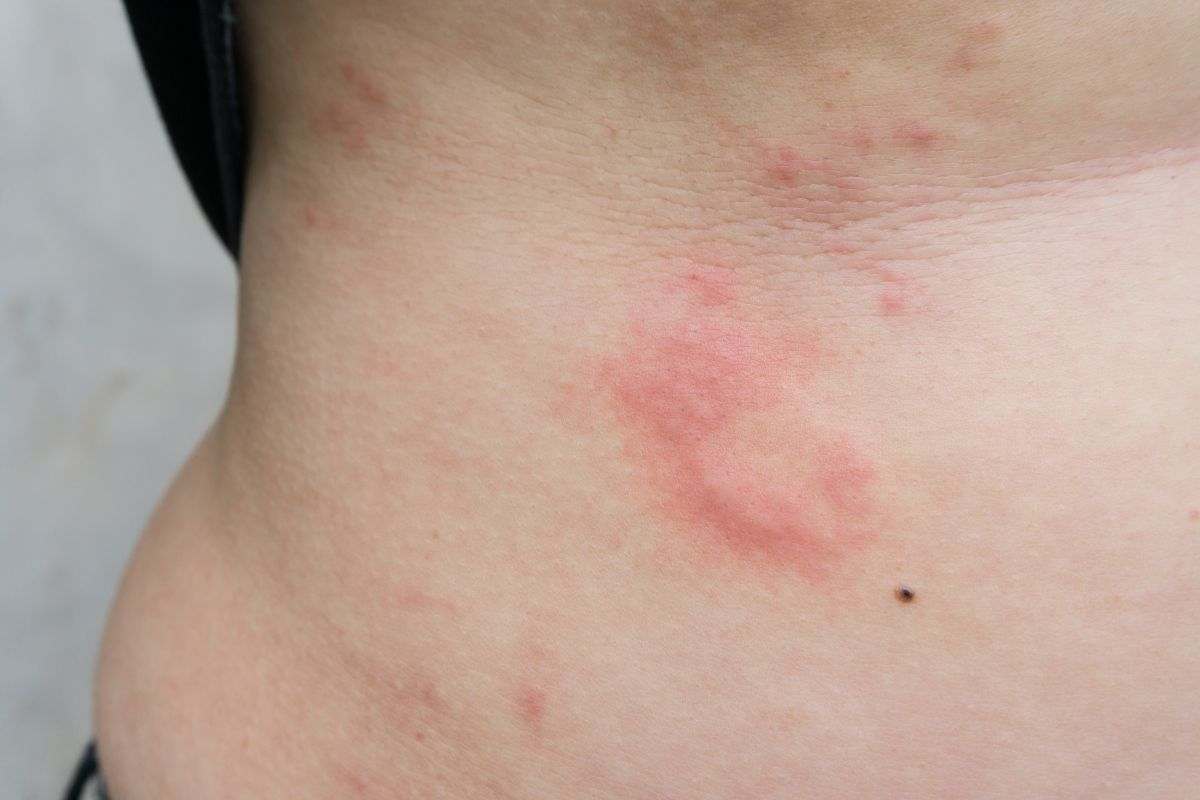 sintomi orticaria da mare