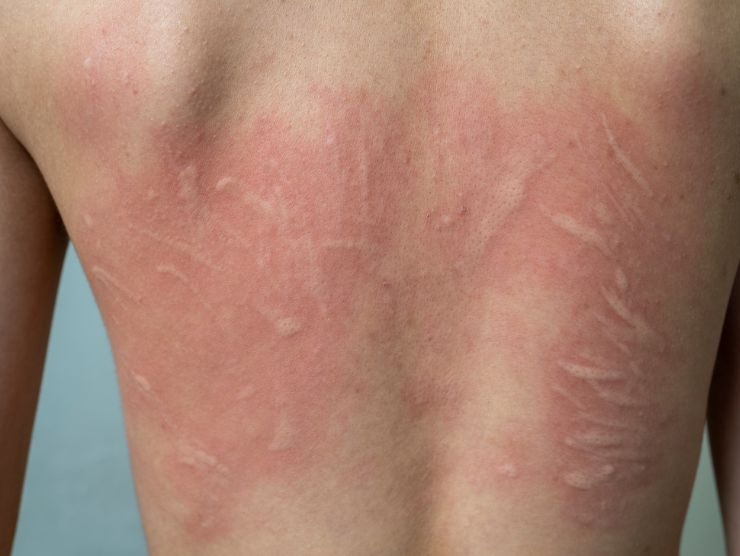 risolvere orticaria da mare