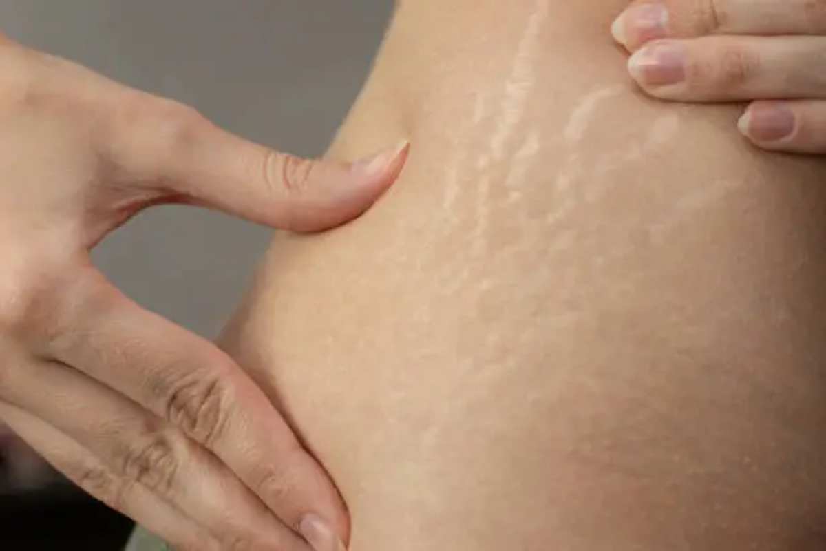 CONTRASTARE IL PROBLEMA DELLE SMAGLIATURE