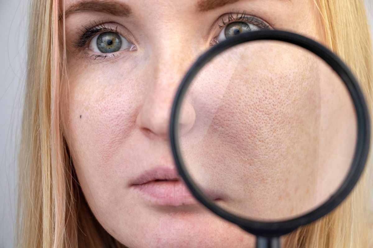pori dilatati: ecco come evitarli