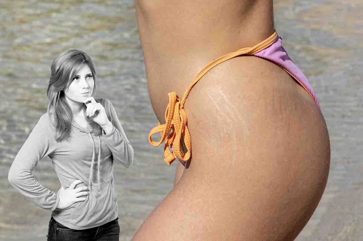 metodo eliminare smagliature pelle