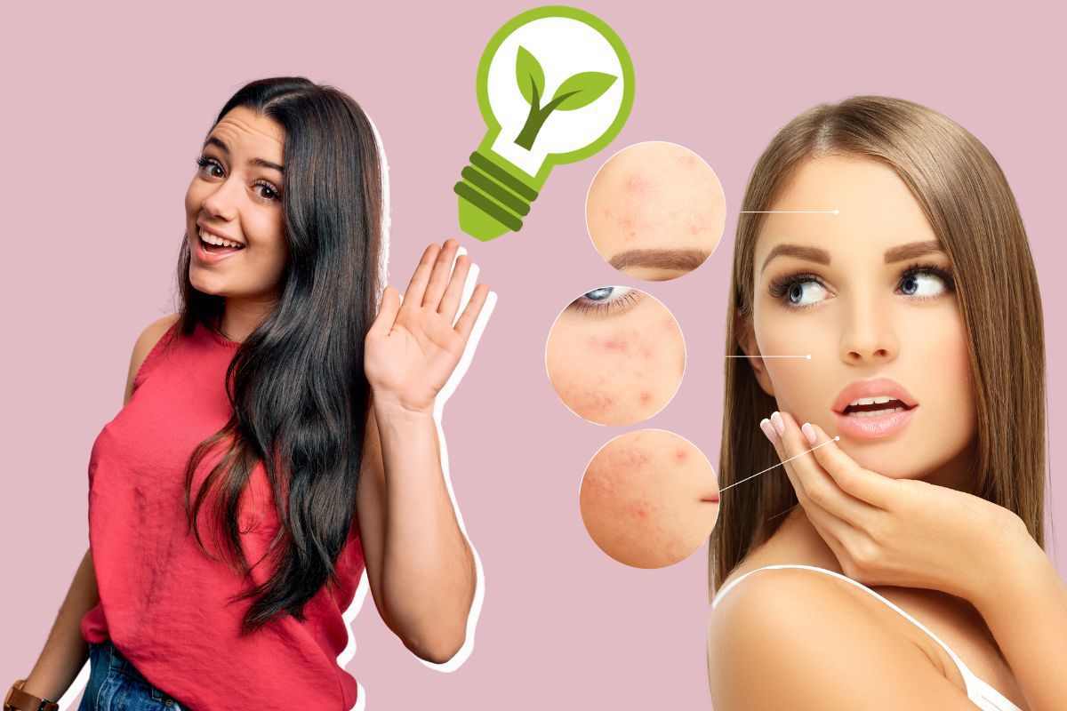 come combattere acne naturalmente