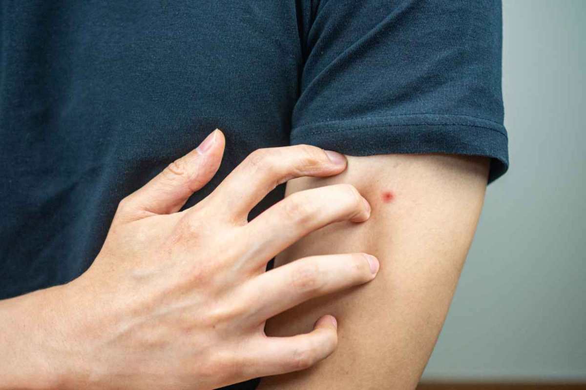 come riconoscere le punture delle cimici dei letti