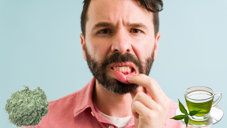 Puoi curare le gengiviti con prodotti naturali