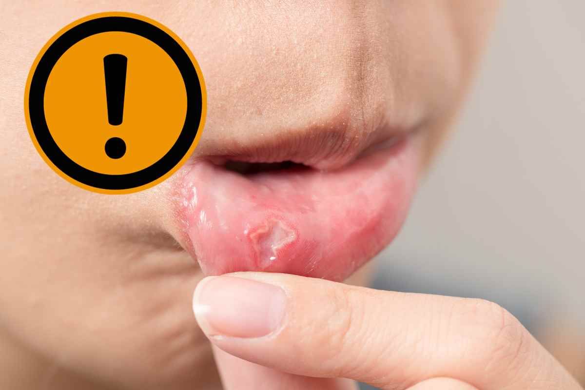 Do you suffer from recurring ulcers?  Your oral health will be safe with these supplements: science is sure of it