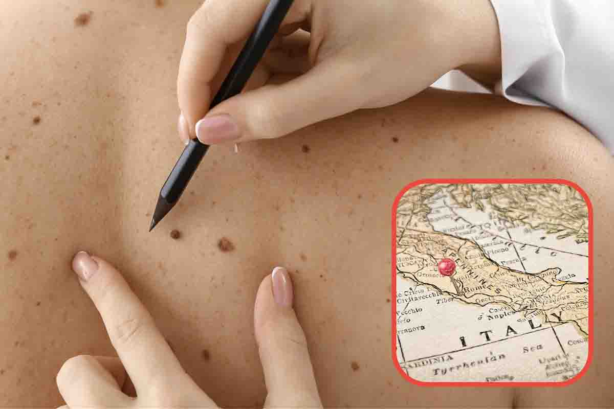 Prevenzione tumori della pelle iniziativa permette una visita gratis