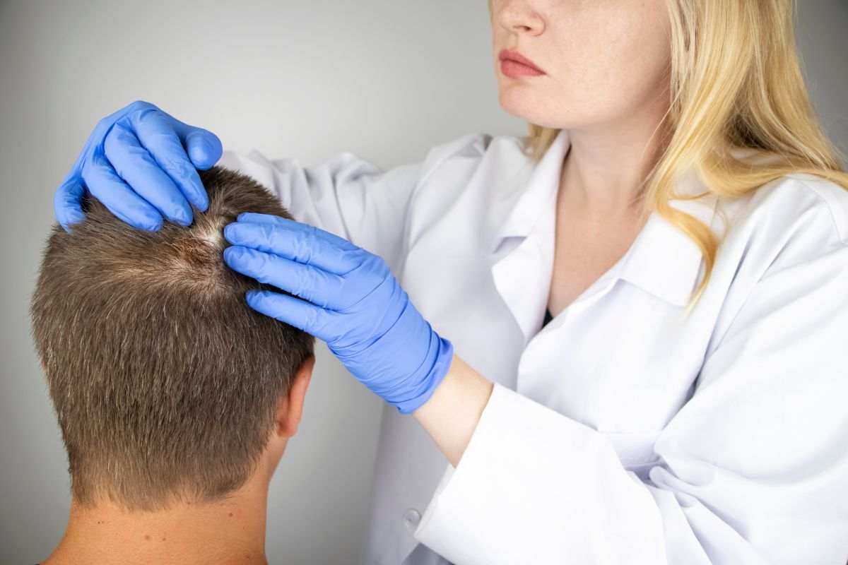 cura alopecia funziona 