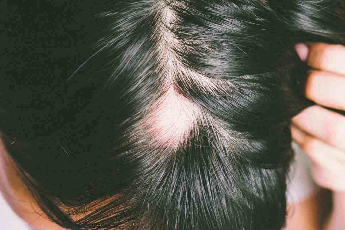 il nuovo farmaco contro la caduta dei capelli funziona