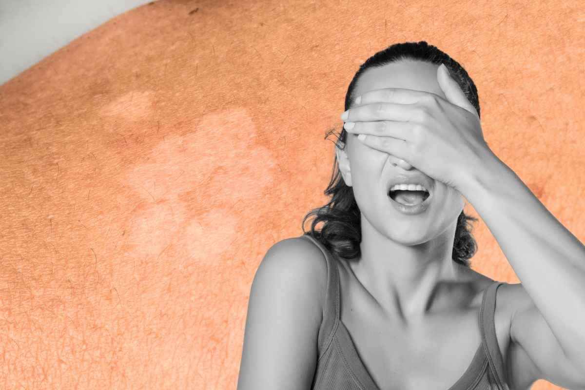 vitiligine come si cura