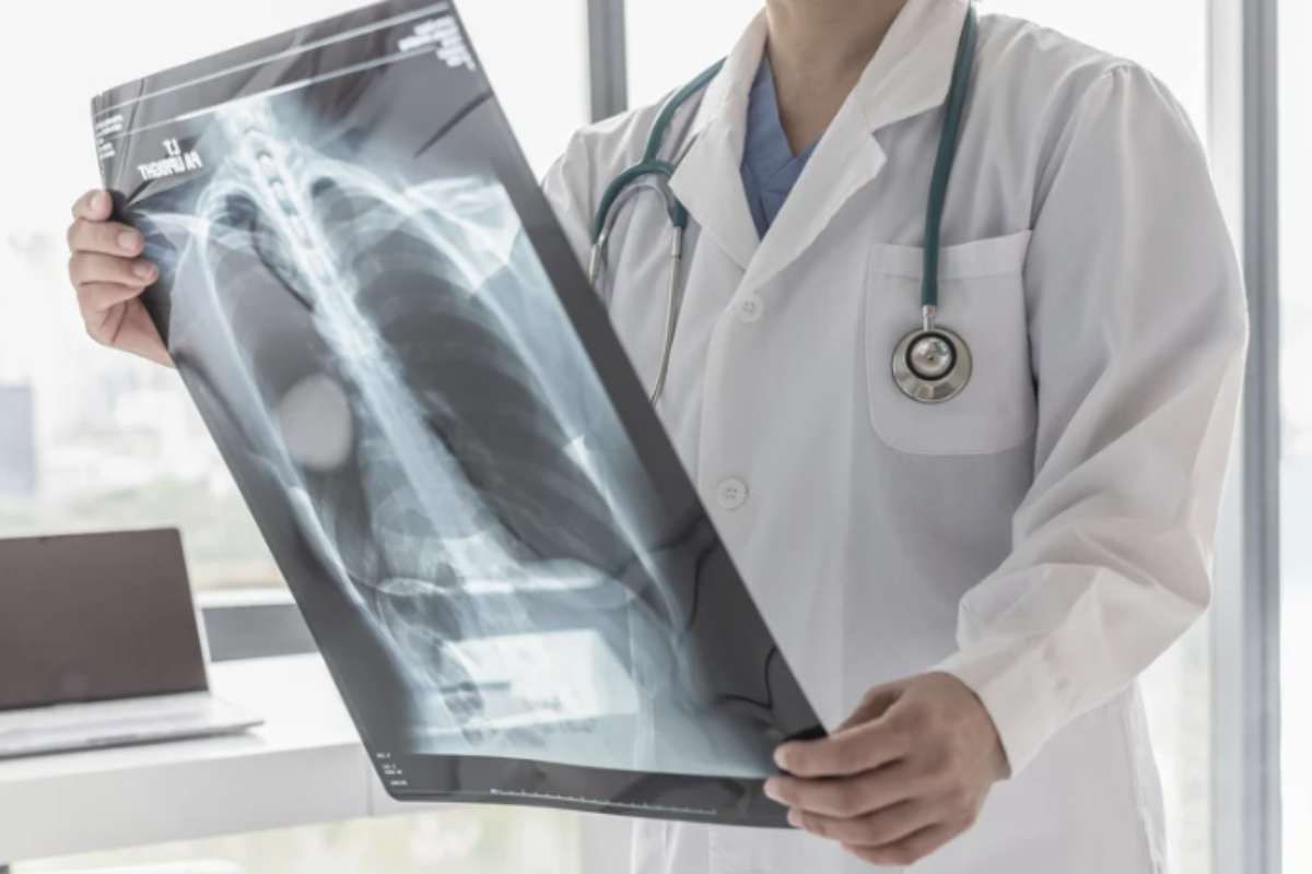 Il tumore alle ossa è una forma di cancro che può originarsi direttamente dalle cellule ossee