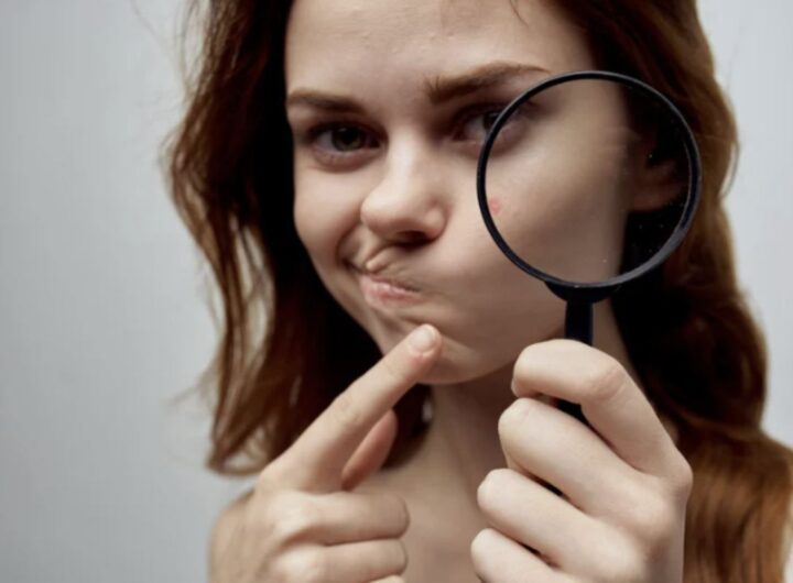 Per chi cerca soluzioni naturali all'acne, esistono diversi rimedi che possono alleviare i sintomi e migliorare la salute della pelle.