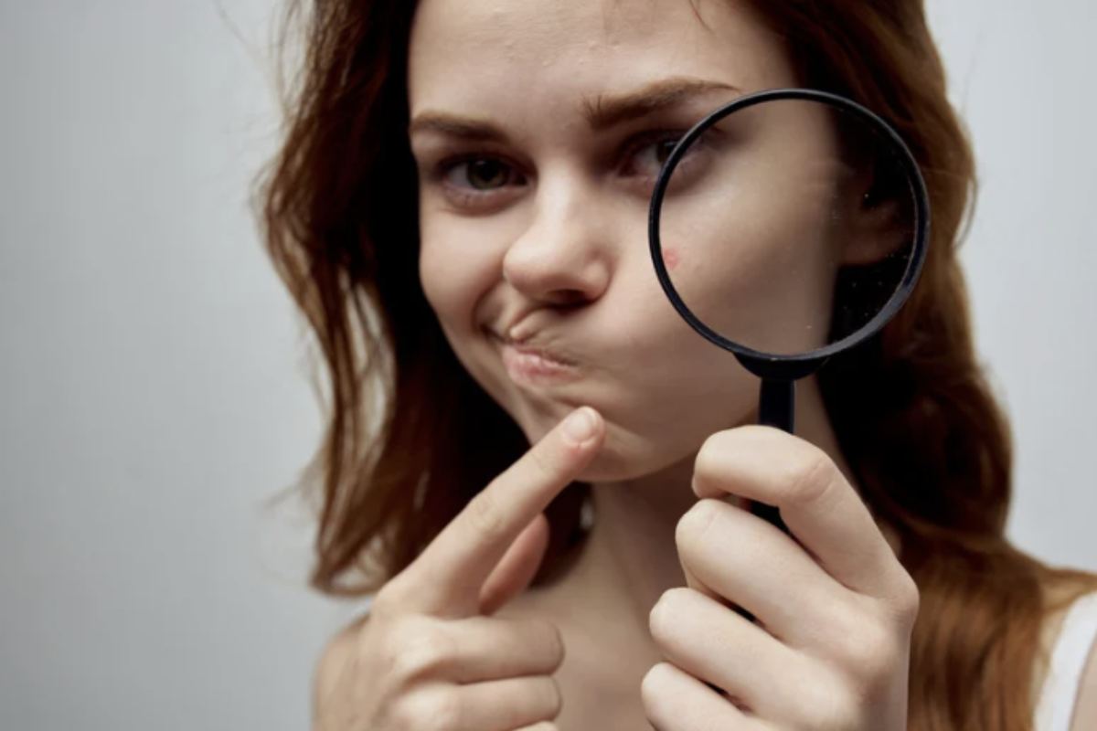 Per chi cerca soluzioni naturali all'acne, esistono diversi rimedi che possono alleviare i sintomi e migliorare la salute della pelle.