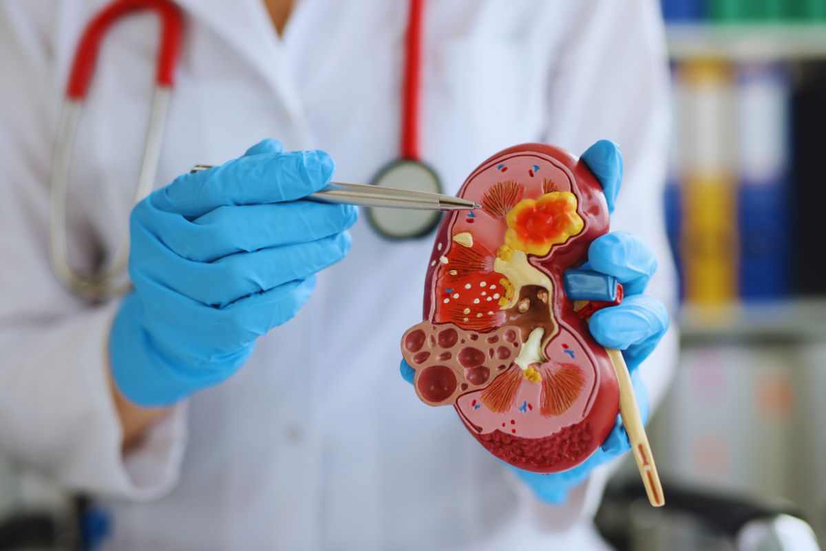 correlazione tra dolore lombare e tumore del rene